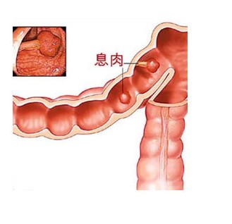 肠息肉症状