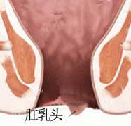肛乳头瘤