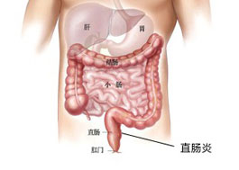 直肠炎症状