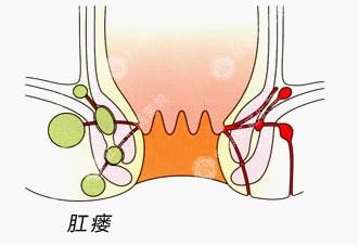 肛瘘预防