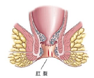 肛裂危害