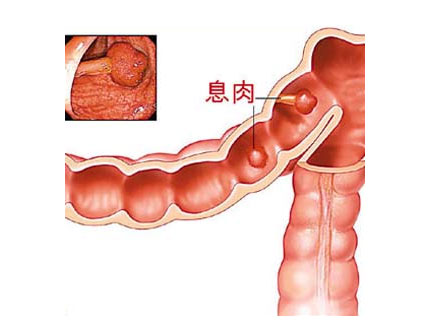 息肉