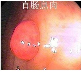 误把息肉当痔疮便血自诊入“雷区”