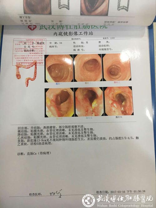电子肛肠镜检查