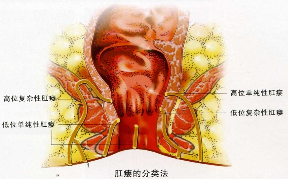 孕妇痔疮怎么治_孕妇外痔疮最佳的自愈方法_孕妇痔疮怎么治最有效果