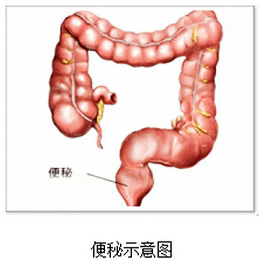 便秘原因