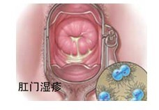 肛门湿疹原因